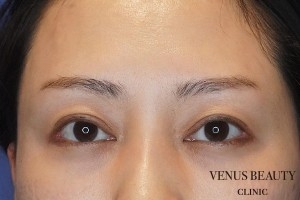 眼瞼下垂症 施術後