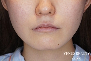 口角挙上 施術前