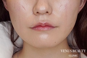 口角挙上 施術後