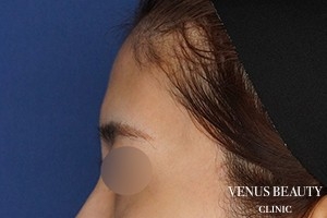 脂肪注入 施術前