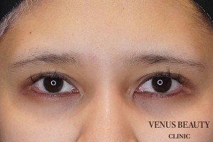 目尻切開 施術前