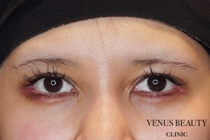 目尻切開 施術後