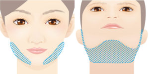 脂肪吸引糸リフト
