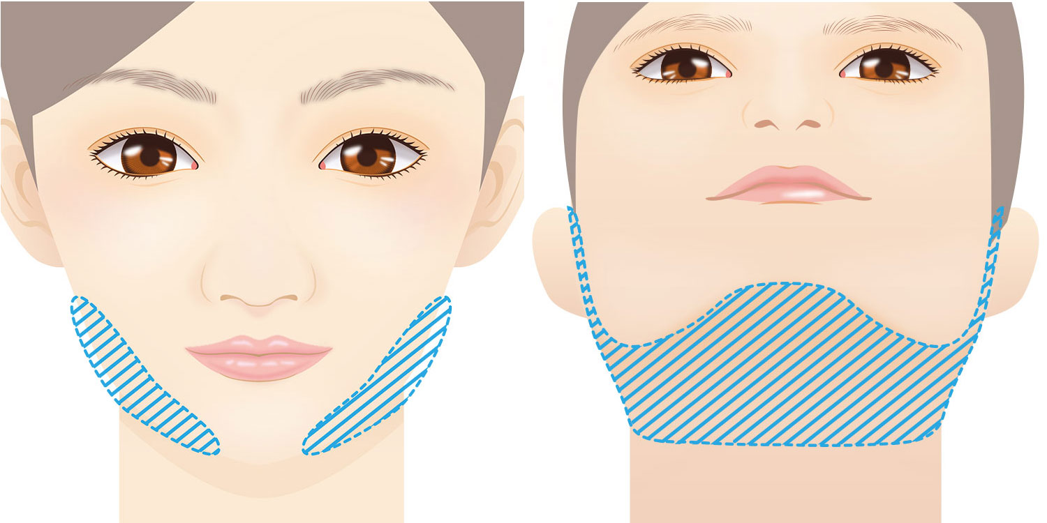 脂肪吸引糸リフト