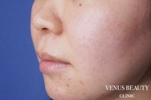 人中窩形成 施術前