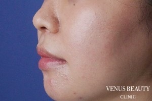 人中窩形成 施術後