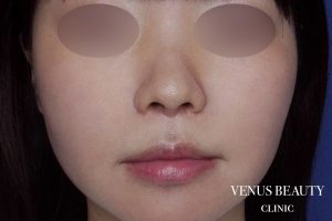 人中短縮術 施術後