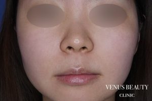 人中短縮術 施術前