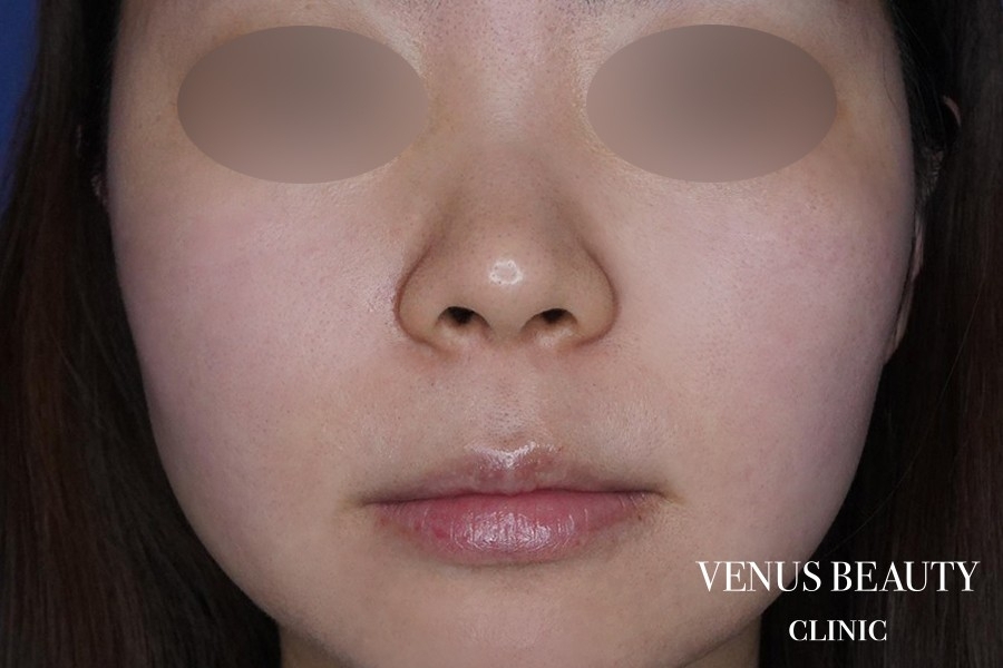 人中窩形成 施術前