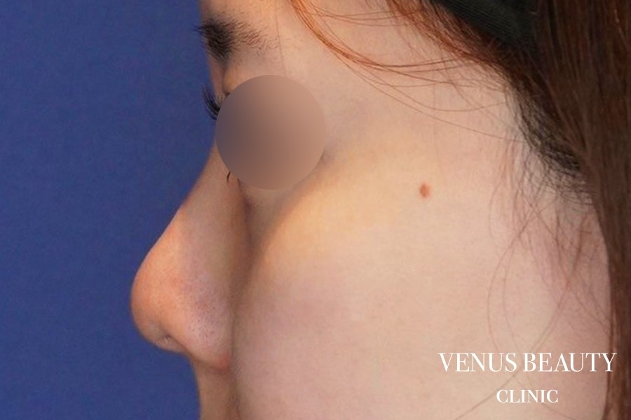 耳介軟骨移植 施術前