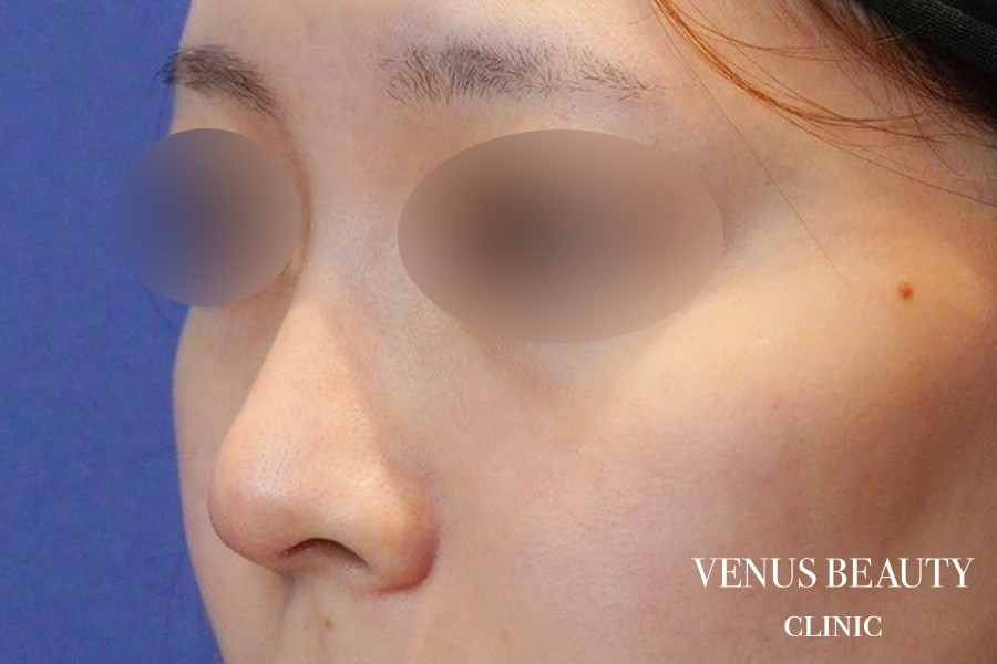 耳介軟骨移植 施術前