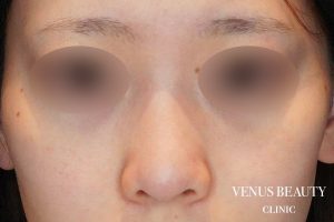 鼻尖形成 施術前