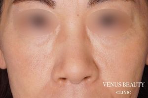 鼻尖形成 施術後