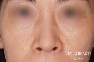 鼻尖形成 施術前