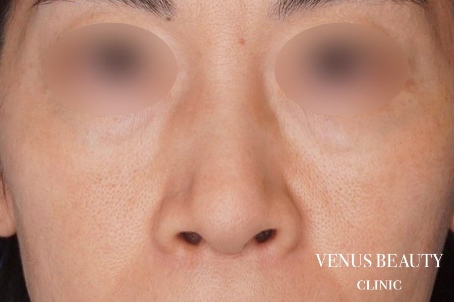 鼻尖形成 施術前