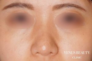 鼻尖形成 施術後