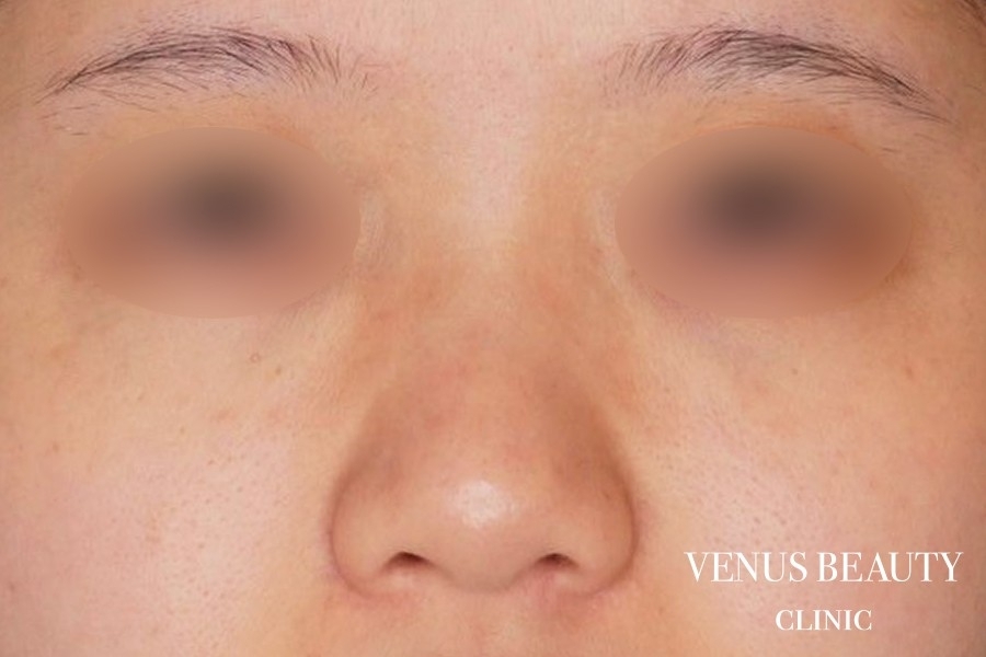 鼻尖形成 施術前