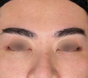 下まぶたのくぼみ修正 施術後