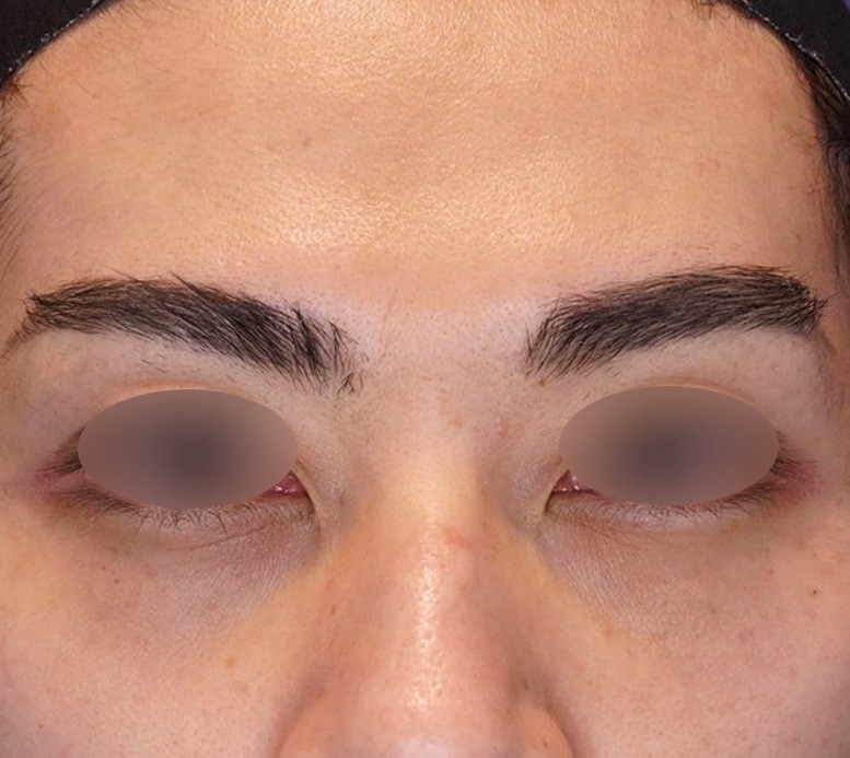 下まぶたのくぼみ修正 施術前