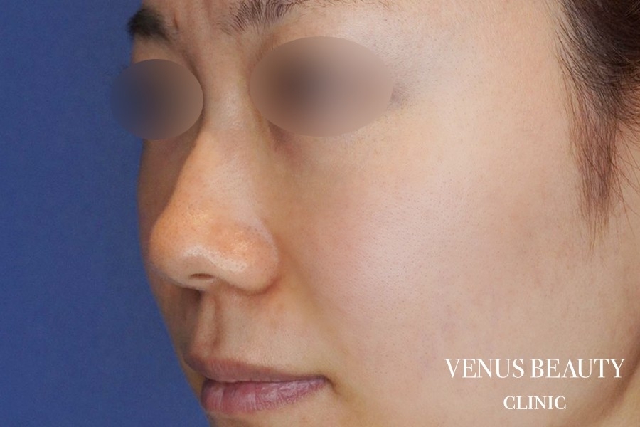 耳介軟骨移植 施術前