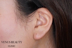 耳たぶ縮小術 施術前