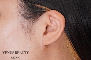 耳たぶ縮小術 施術後