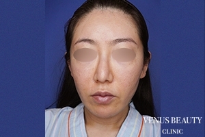 ネックリフト 施術前