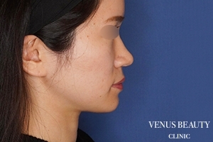 糸リフト＋脂肪吸引 施術後