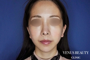 フルフェイスリフト 施術後