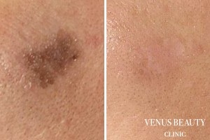 ピコレーザー 施術後