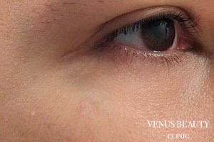 ピコレーザー 施術後