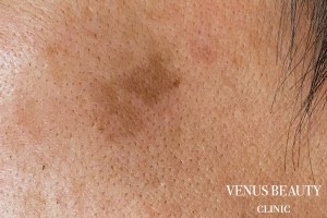 ピコレーザー 施術前