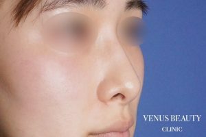 鼻孔緑軟骨移植 施術前