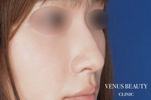 鼻孔緑軟骨移植 施術後