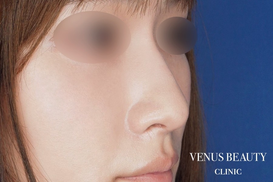 鼻孔緑軟骨移植 施術後