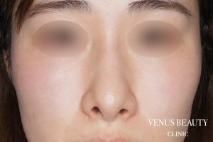 鼻孔緑軟骨移植 施術前