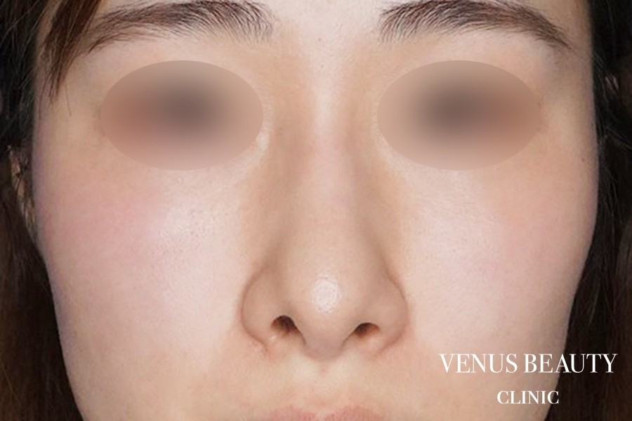 鼻孔緑軟骨移植 施術前