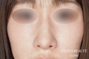 鼻孔緑軟骨移植 施術後