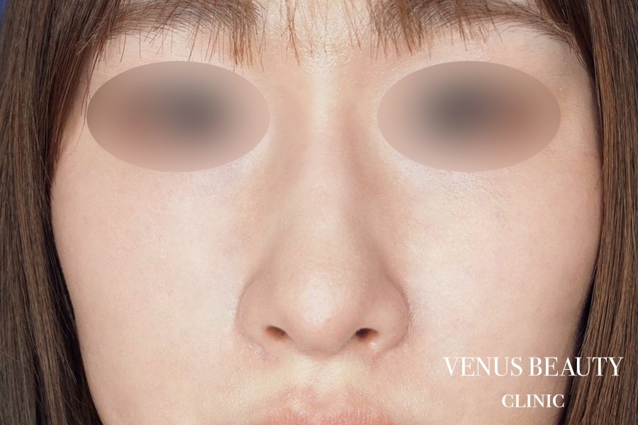 鼻孔緑軟骨移植 施術後