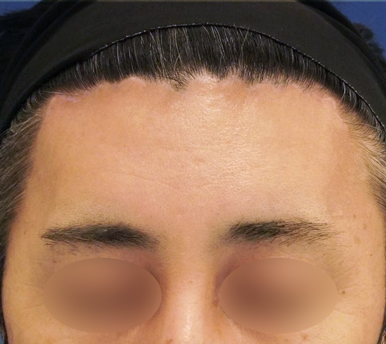 額リフト 施術後