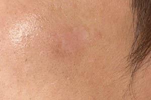 ピコレーザー施術後2週間