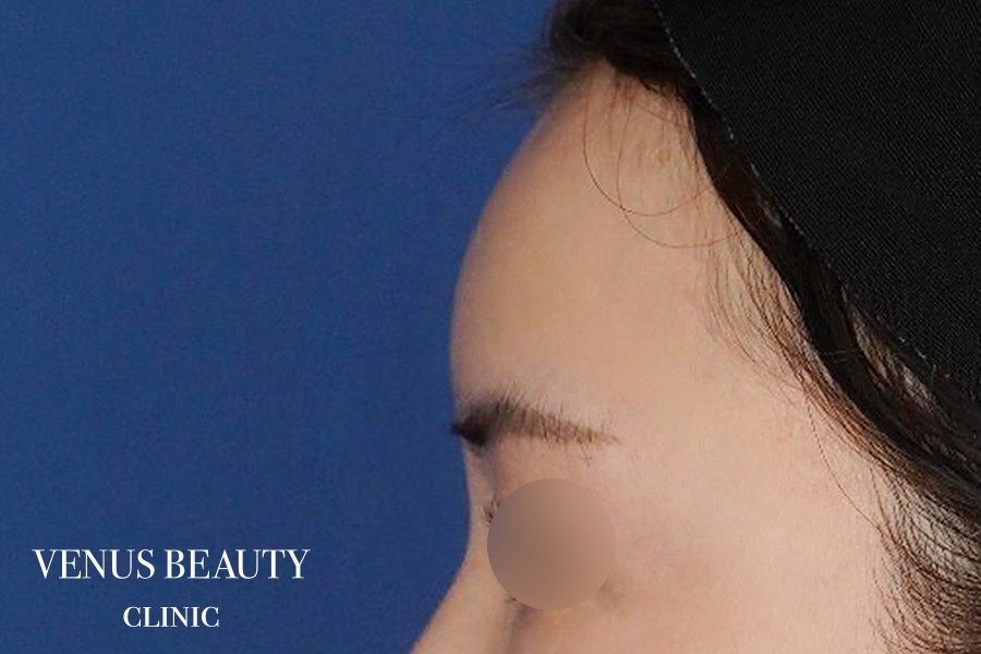 脂肪注入 施術後