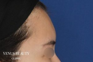 脂肪注入 施術前