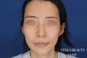 脂肪注入 施術前