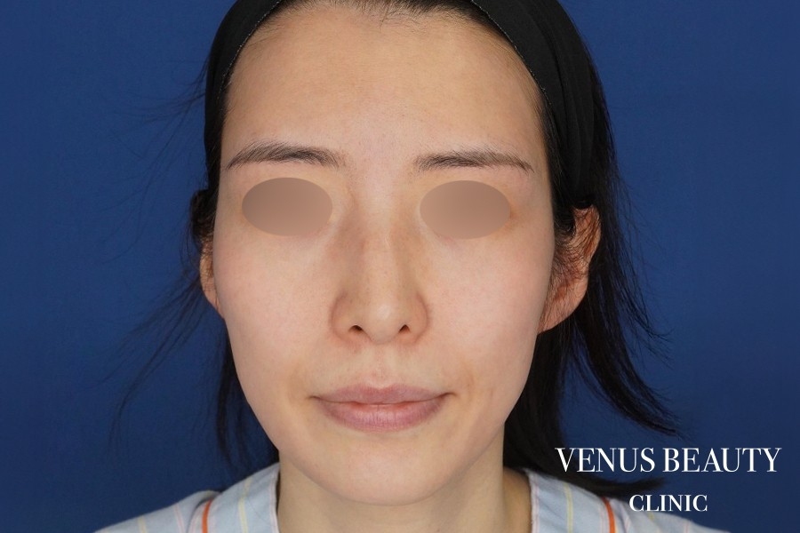 脂肪注入 施術前