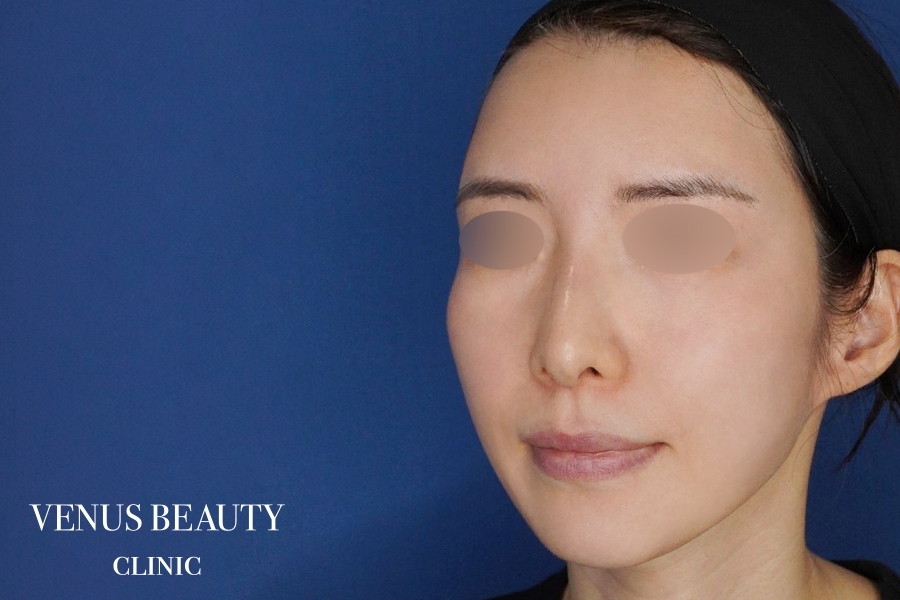 脂肪注入 施術後