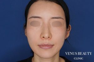 脂肪注入 施術後