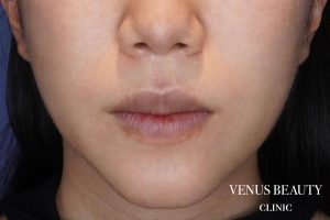 M字リップ形成 施術前