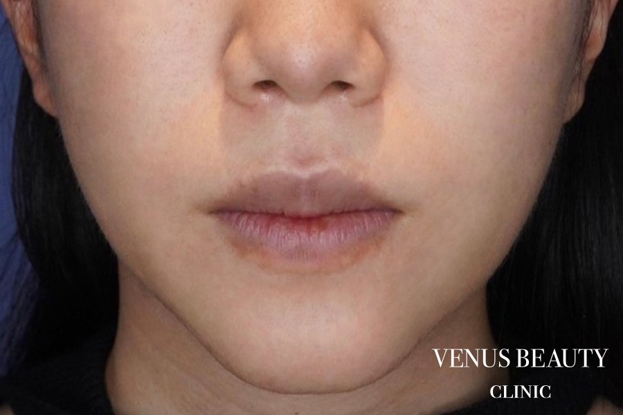 M字リップ形成 施術前