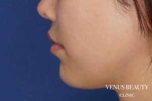 人中短縮術 施術後